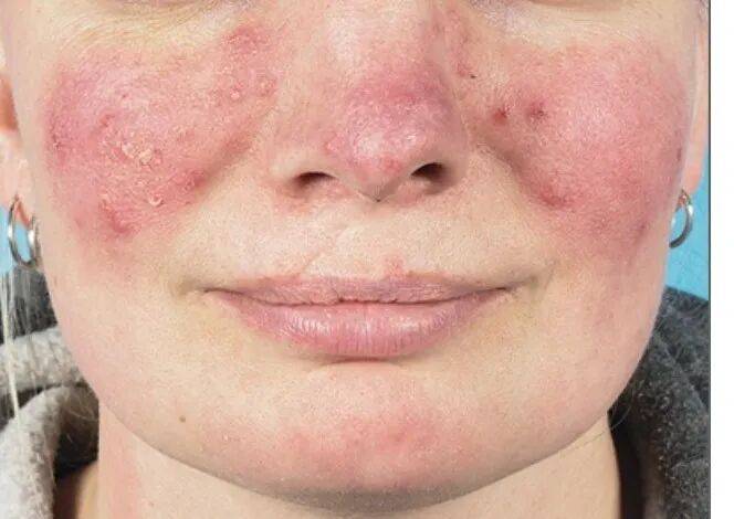 美麗的誤會：當“玫瑰”不是花，而是玫瑰痤瘡