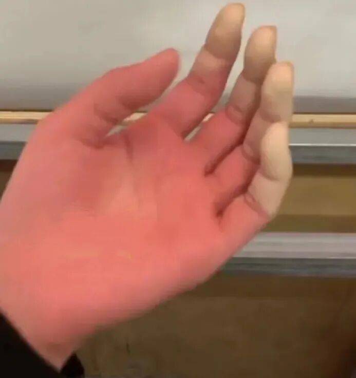 四川女大學生東北雪地裡摔暈後，3根手指或面臨截肢