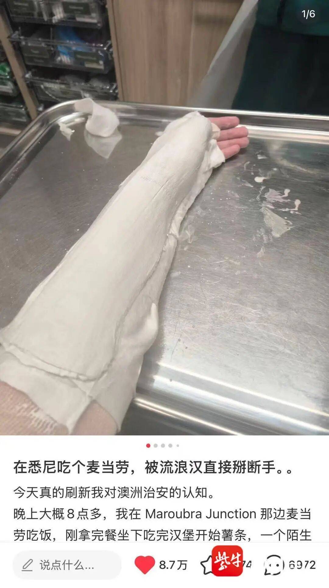 中國留學生在悉尼吃麥當勞，遭暴力搶奪薯條，“手被流浪漢掰斷”， 當事人還原經過