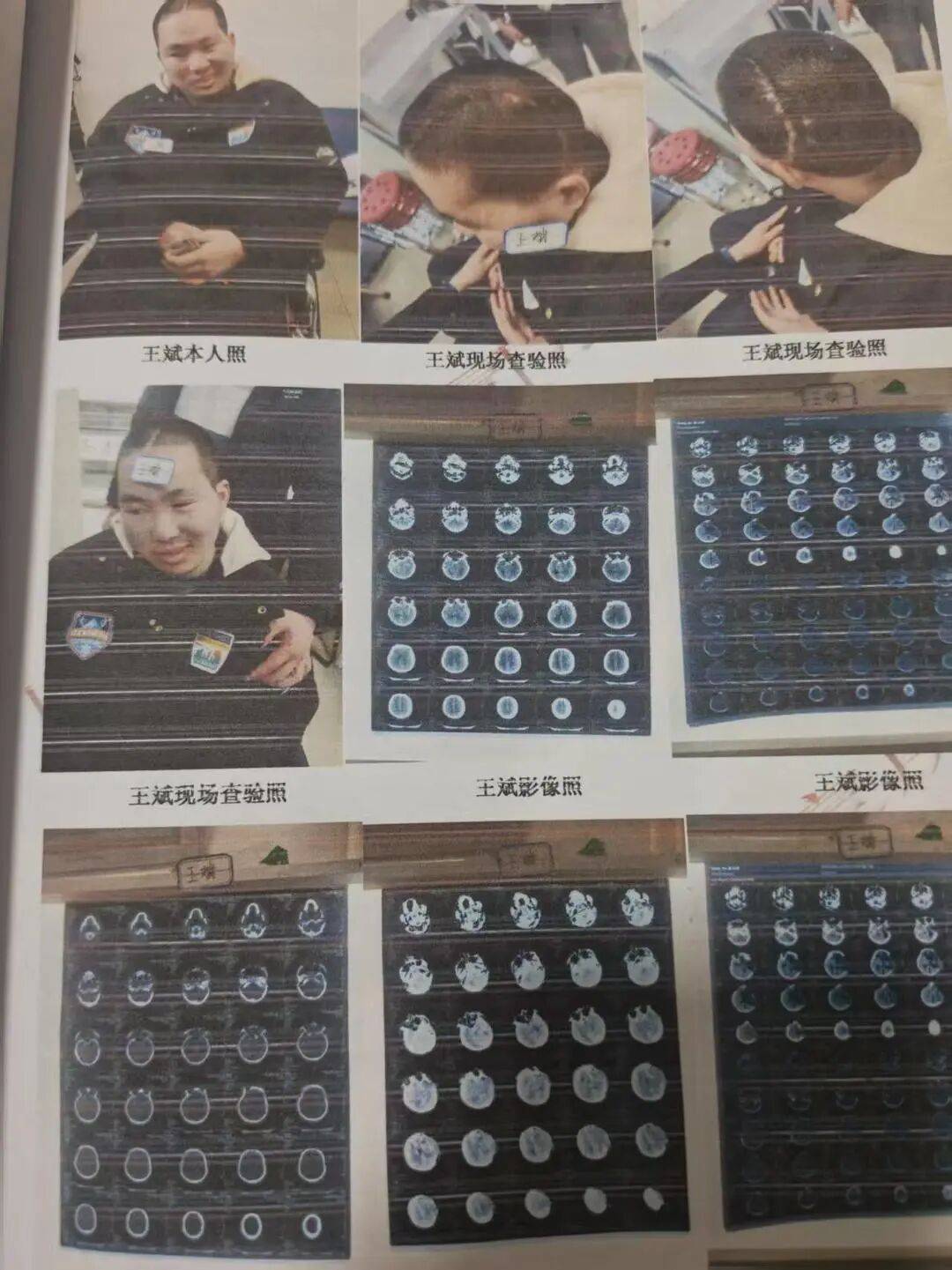16歲少年無證駕車撞倒23歲研究生，致其顱腦損傷心智如幼童，肇事者無力支付28萬賠償，父親：他想輟學還債，不行，我來還